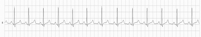 Normal Sinus Rhythm_Rhythm Strip